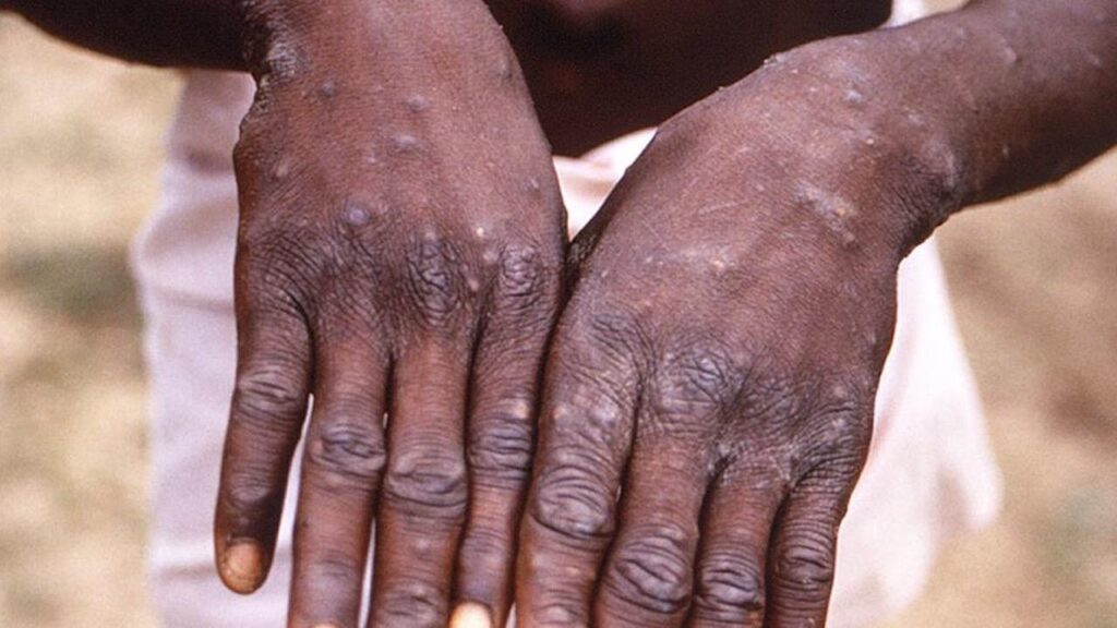 Faut-il s’inquiéter de la propagation de la variole du singe en Haïti ?